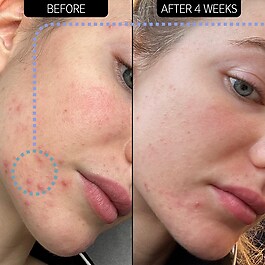 Blemish Clearing Moisturizer 2% NovoRetin - Nawilżający krem na noc